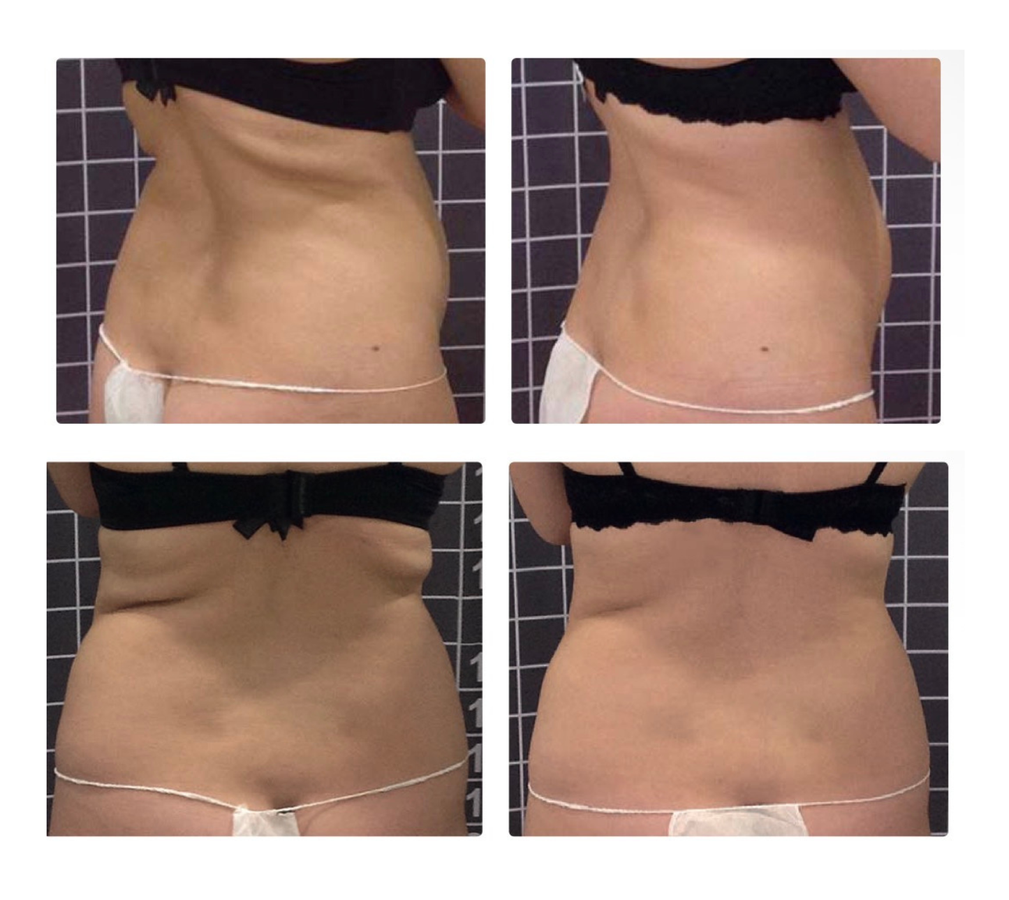 Pack Reductivo Rollos de Espalda – 12 Sesiones