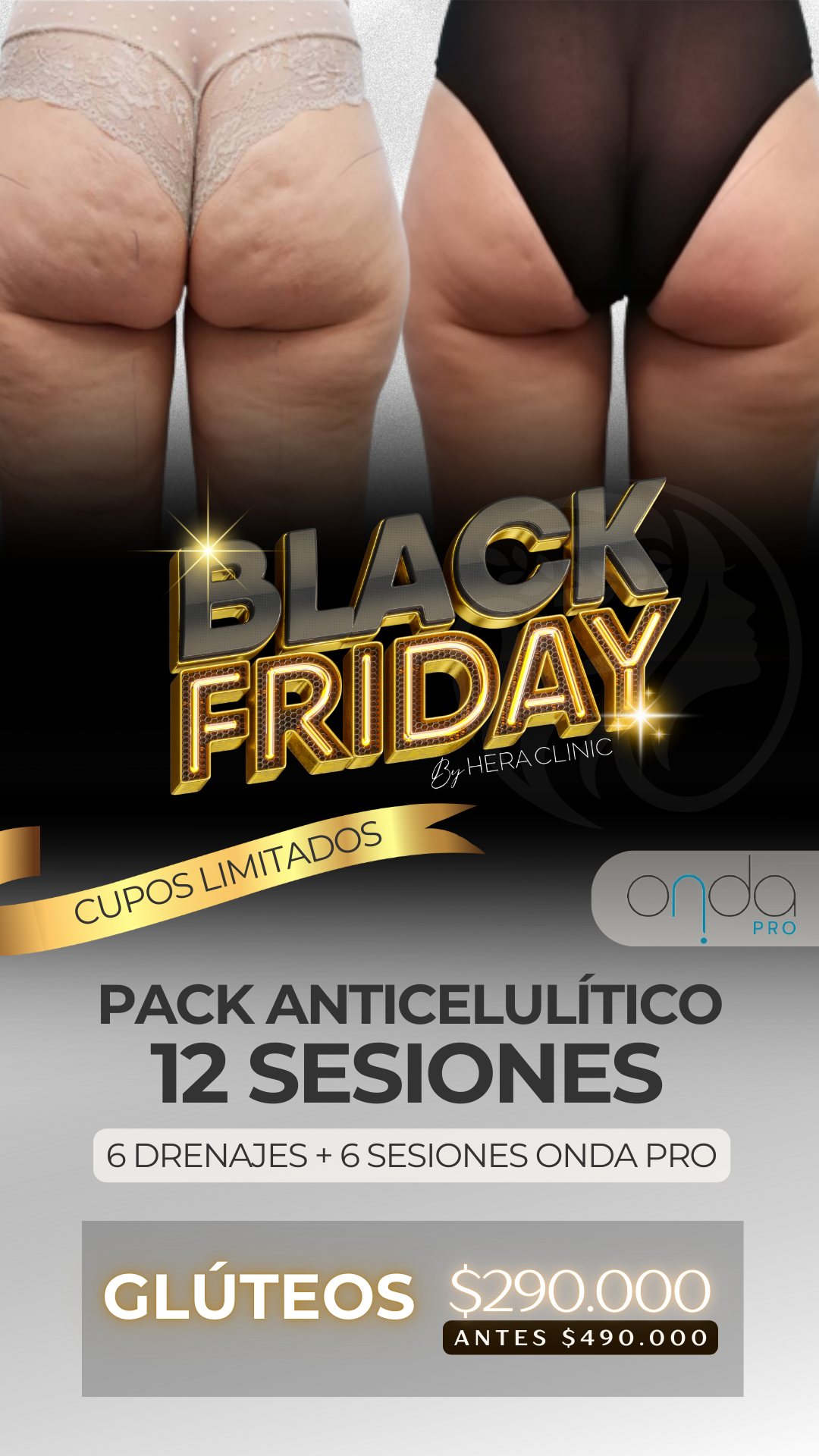 Pack Anticelulítico Glúteos – 12 Sesiones (Black Friday)