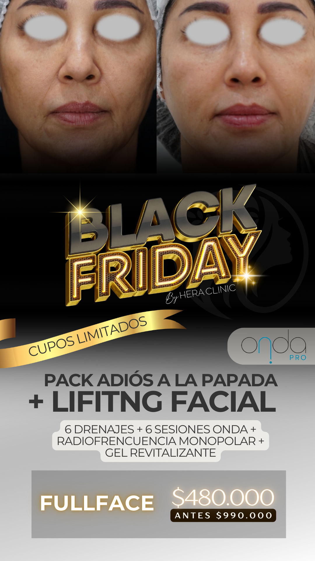 Pack Adiós a la Papada + Lifting Facial – Full Face (12 Sesiones | Black Friday)