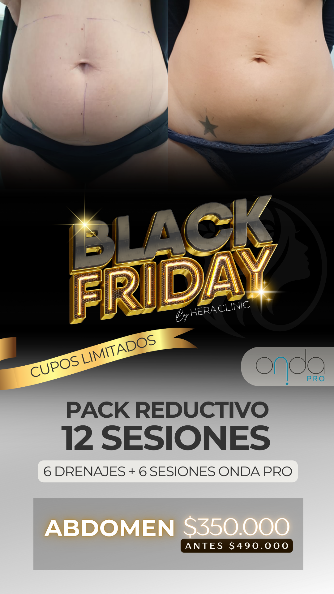 Pack Reductivo Black Friday – 12 Sesiones (Abdomen)