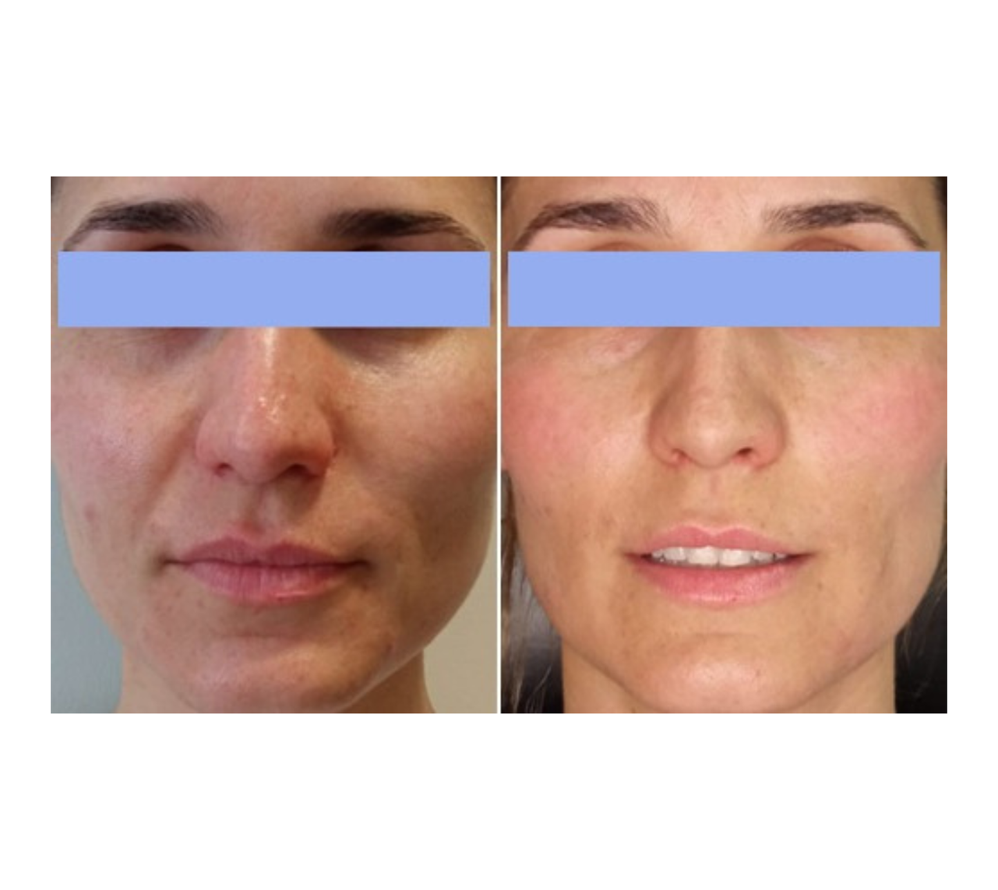 Pack Adiós a la Papada + Lifting Facial – Full Face (12 Sesiones | Promo de verano)