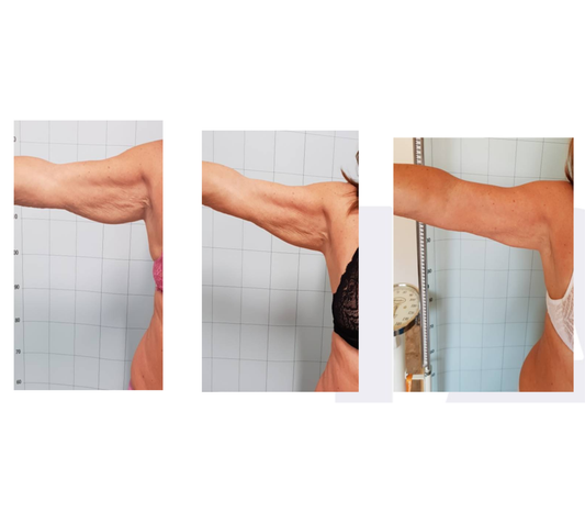 Pack Re-Afirma Tus Brazos – 12 Sesiones