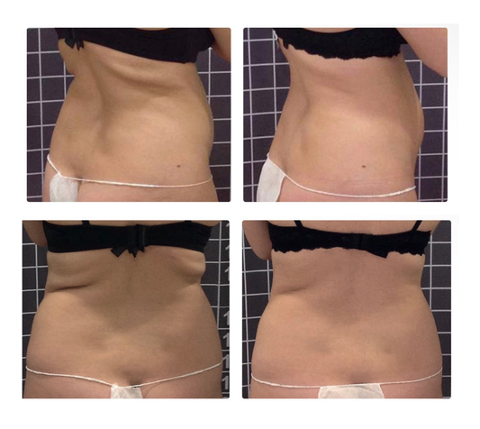 Pack Reductivo Rollos de Espalda – 12 Sesiones