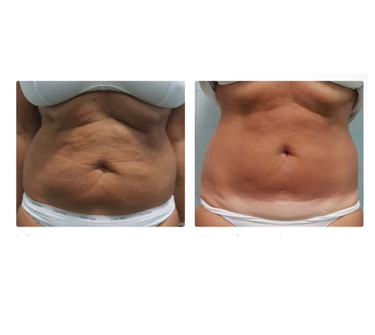 Pack Reductivo – 12 Sesiones (Abdomen)