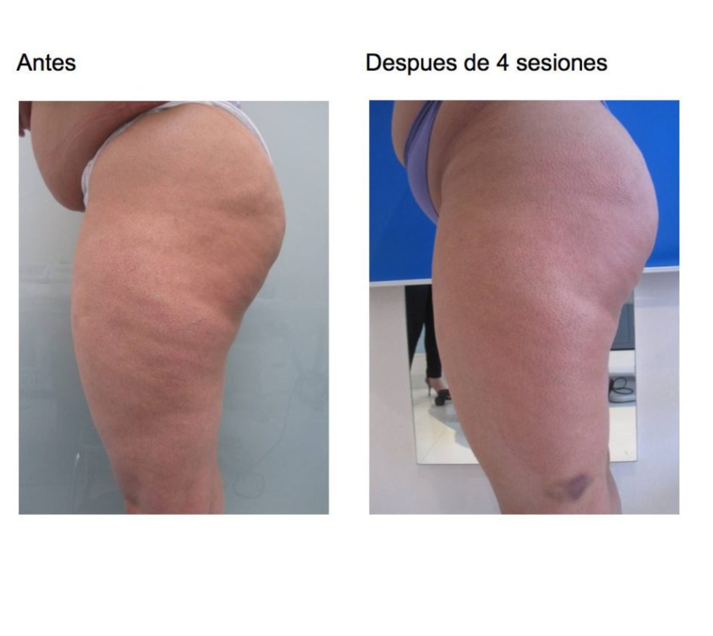 Pack Anticelulítico Piernas + Glúteos – 12 Sesiones