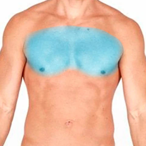 PECHO COMPLETO 6 SESIONES SOPRANO ICE