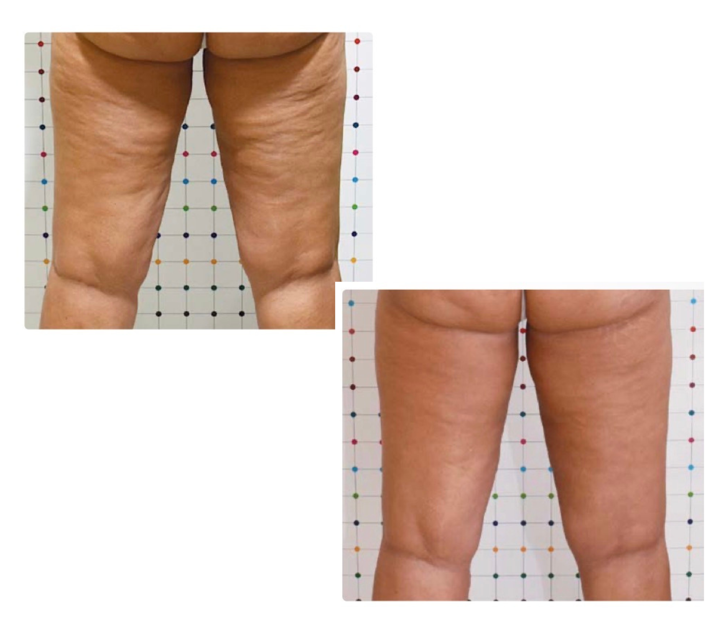 Pack Anticelulítico Piernas + Glúteos – 12 Sesiones