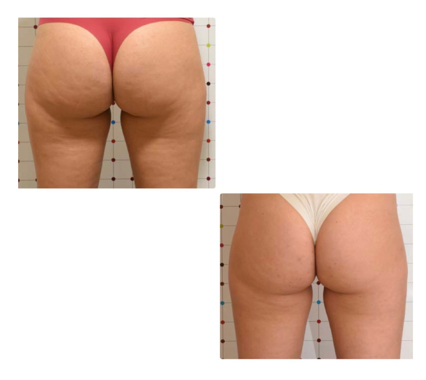 Pack Anticelulítico Piernas + Glúteos – 12 Sesiones