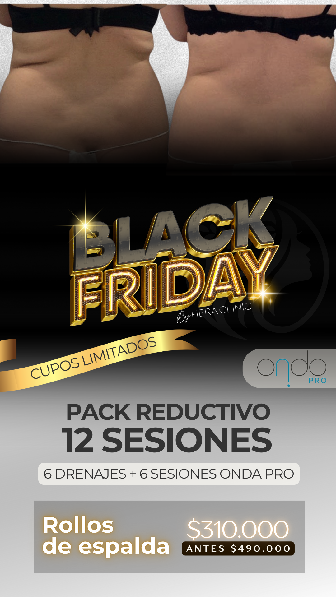 Pack Reductivo Rollos de Espalda – 12 Sesiones (Black Friday)