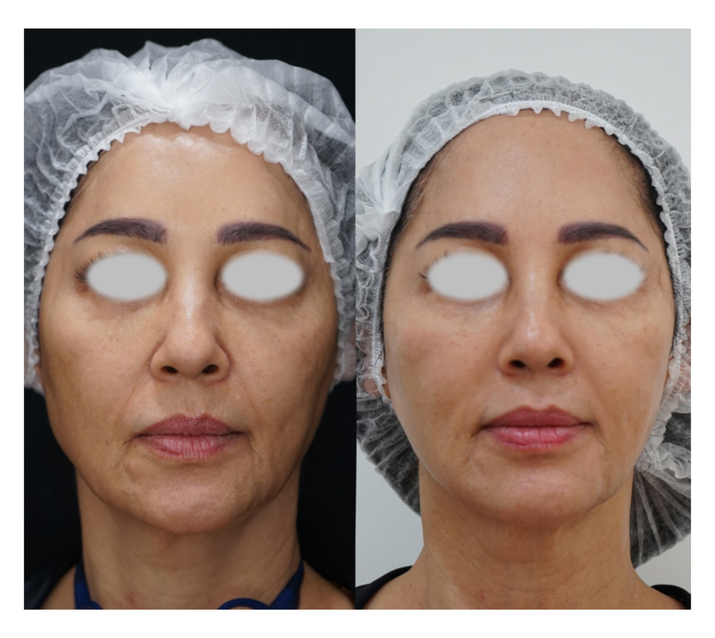 Pack Adiós a la Papada + Lifting Facial – Full Face (12 Sesiones | Promo de verano)