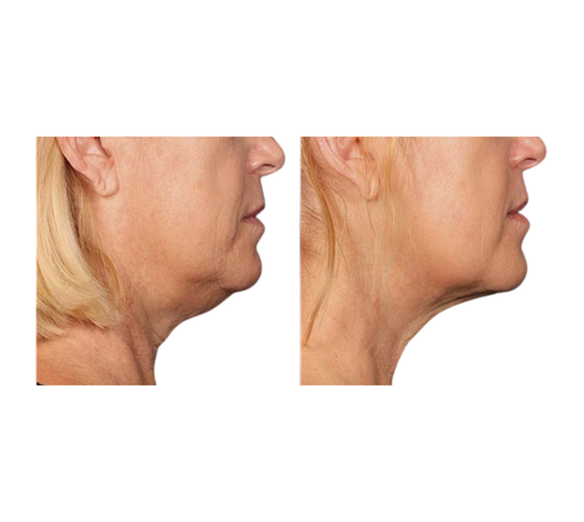 Pack Adiós a la Papada + Lifting Facial – Full Face (12 Sesiones | Promo de verano)