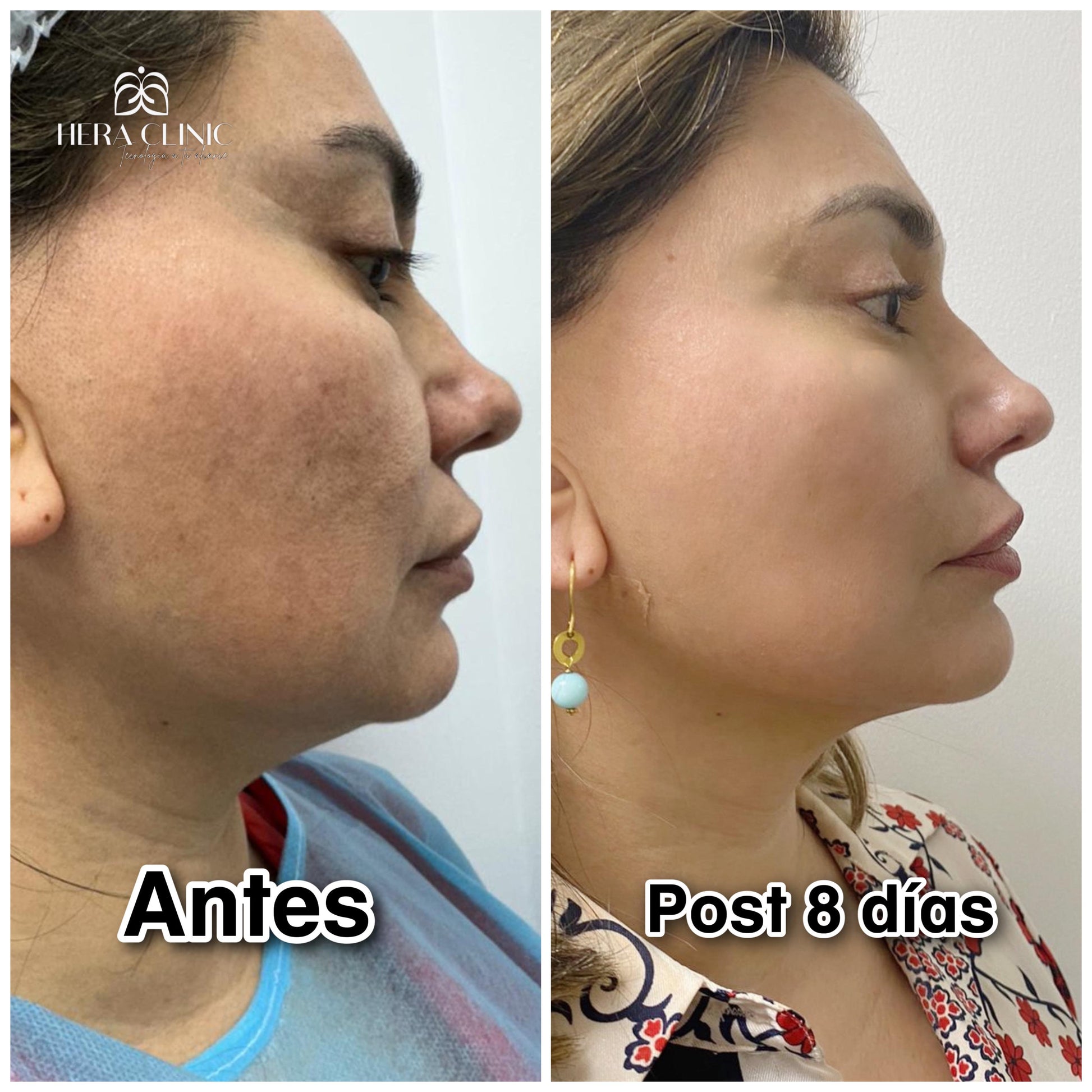 Before And After Lifting Facial Laser Precio Lifting Facial